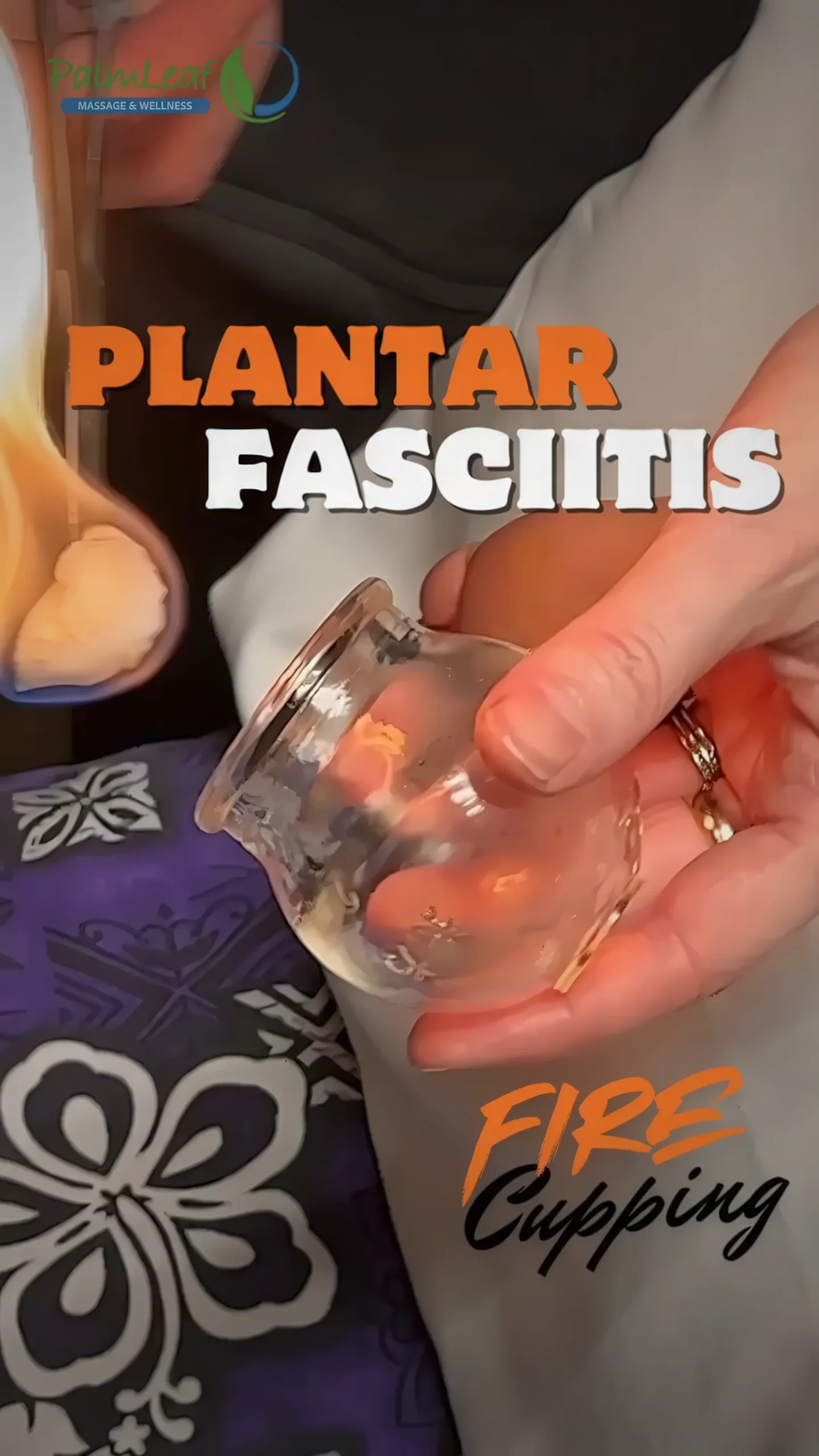 Fire Cupping Plantar Fasciitis